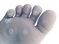 tratamentos-calosidade