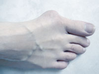 Joanete (Hálux Valgo) Joanete